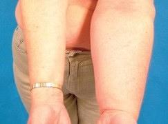 (Risico op) lymfoedeem na borstkanker