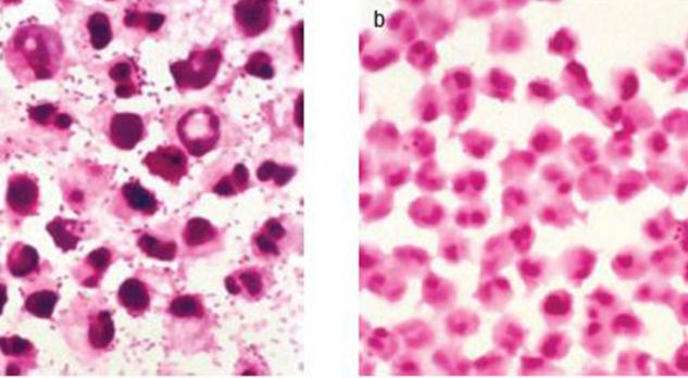 Bacteriële meningitis