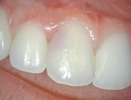 Externe cervicale wortelresorptie
