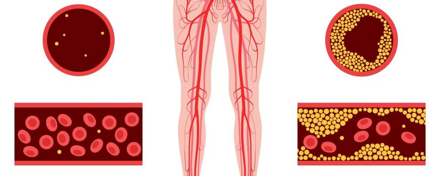 Antitrombotica bij perifeer arterieel vaatlijden