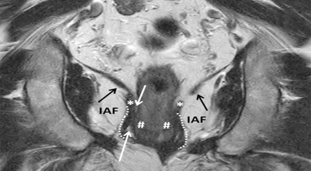 Radiologische beeldvorming van het anuscarcinoom 