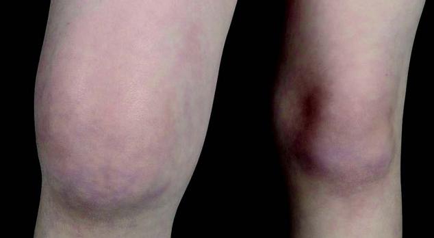 De pijnlijke knie bij kinderen