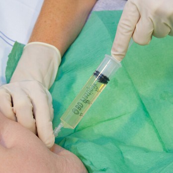 Ascitespunctie in de palliatieve fase 