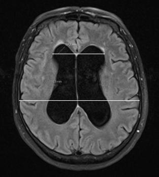 Normaledrukhydrocefalus