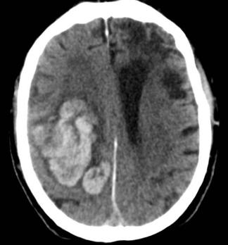 Behandeling van een acute hersenbloeding