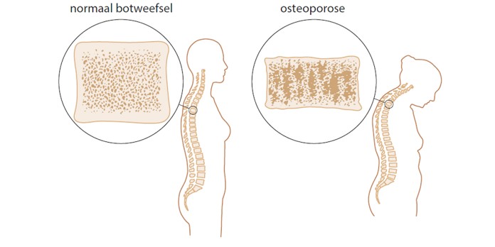 Osteoporose en fractuurpreventie bij kwetsbare ouderen 