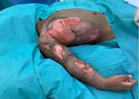 Ernstige brandwonden bij kinderen: van opvang tot IC-zorg