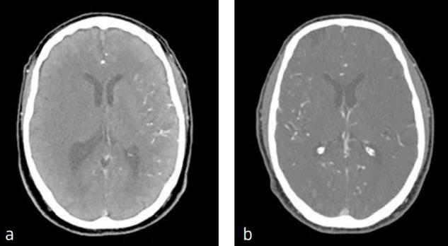 DEFUSE 3 – bevestiging effectiviteit late intra-arteriële therapie voor het herseninfarct: toegevoegde waarde voor de klinische praktijk