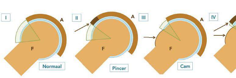 Heupdysplasie en heupimpingement bij (jong)volwassenen nader bekeken