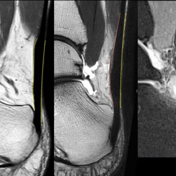 Multidisciplinaire richtlijn achilles-tendinopathie 