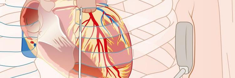 ICD, de levensreddende implanteerbare cardioverterdefibrillator