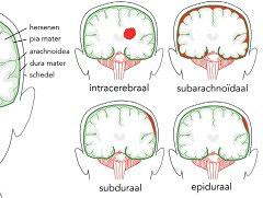 Subarachnoïdale bloeding