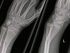 Fracturen