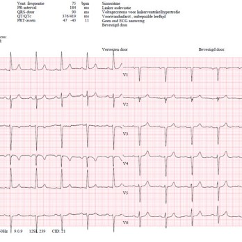 Acuut coronair syndroom na electieve laparoscopische cholecystectomie 