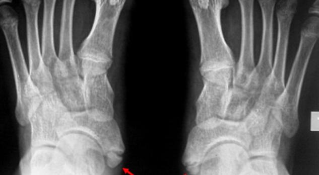 Diagnostiek en behandeling van voetklachten bij kinderen (VI)