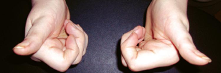 Herziene KNGF-richtlijn Reumatoïde artritis 2018