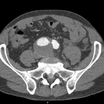 Diepveneuze trombose vanwege compressie door een aorta-iliacaal aneurysma