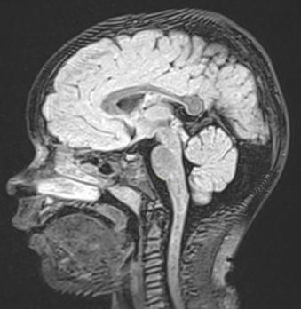 Congenitale malformaties in de achterste schedelgroeve