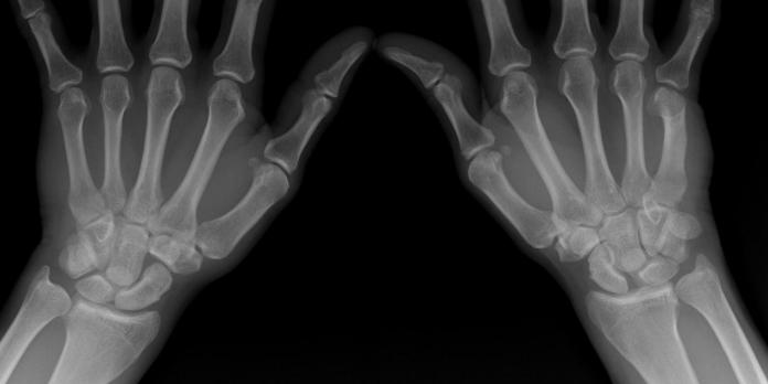 Fysiotherapeutische beoordeling van gesloten polstraumata (VI)