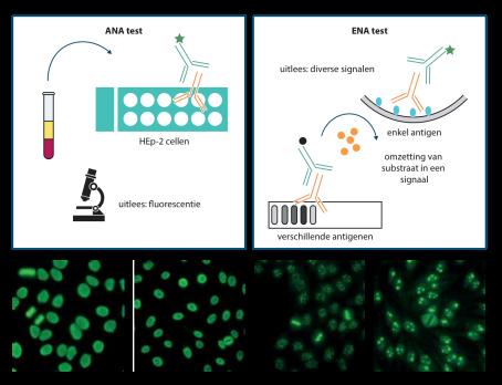 Immuundiagnostiek bij kinderen met verdenking op systemische auto-immuunziekte: ANA en ENA