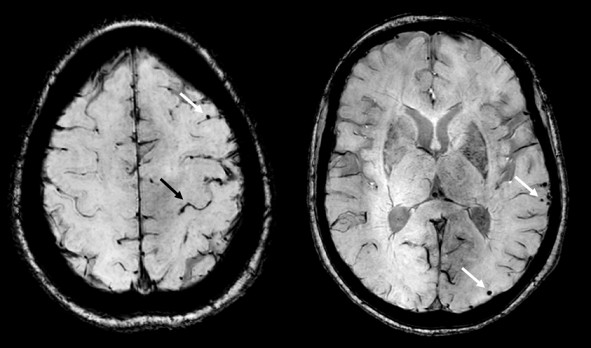 Cerebrale amyloïdangiopathie 