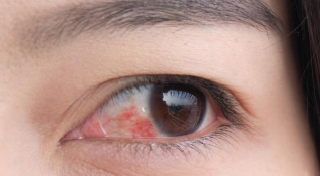 Oogaandoeningen met een rood oog