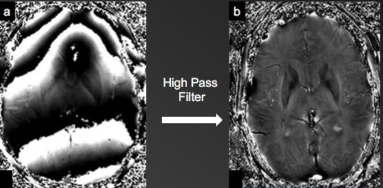 Susceptibility-weighted imaging (SWI) bij verschillende (vasculaire) aandoeningen