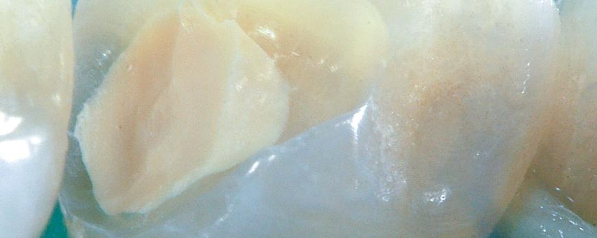 Calciumsilicaatcementen in de endodontie